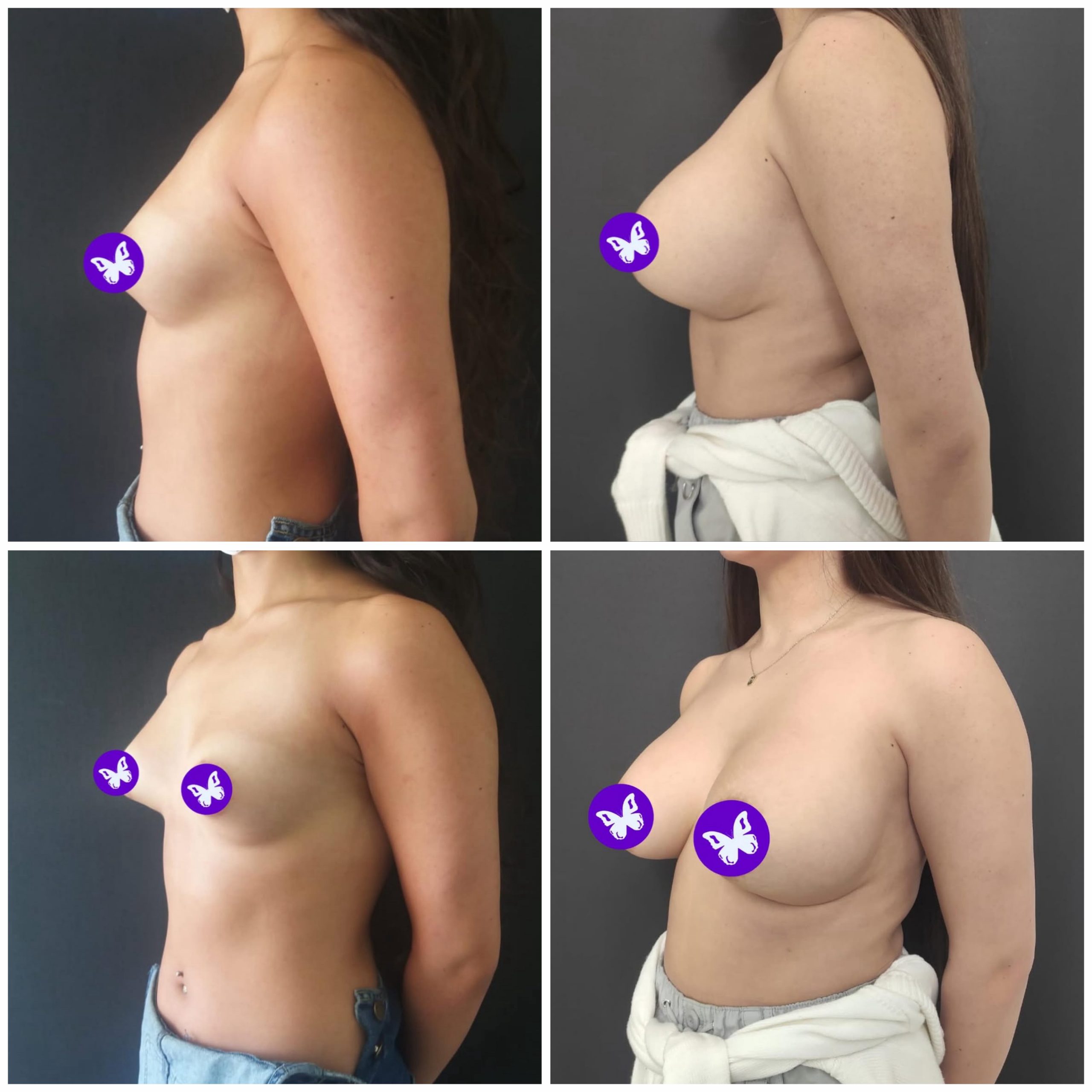 Brustchirurgie
