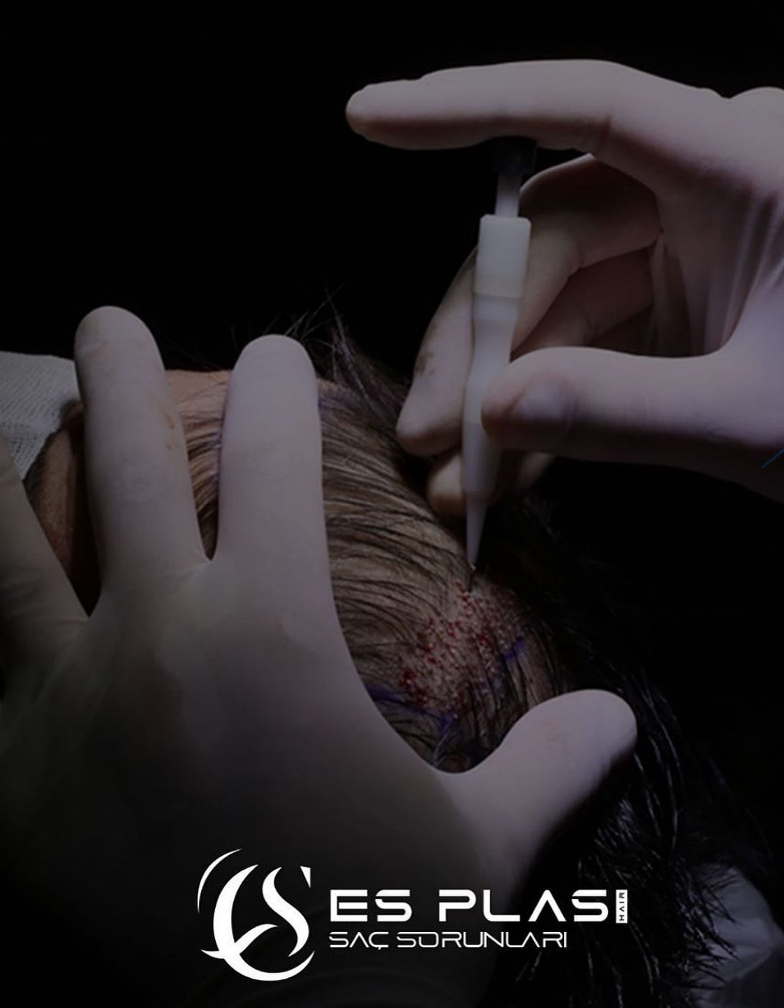 Haartransplantation (FUE & DHI)