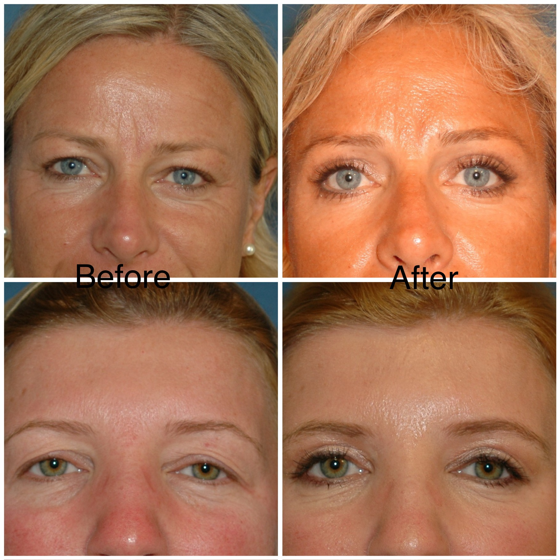 Facelifting & Gesichtsverjüngung