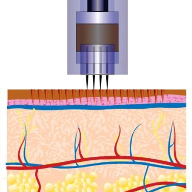 Micro Needling, PRP & Narbenpigmentierung