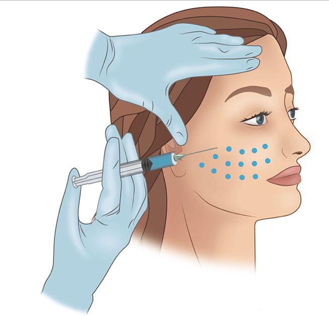 Botox & Hyaluron Unterspritzung